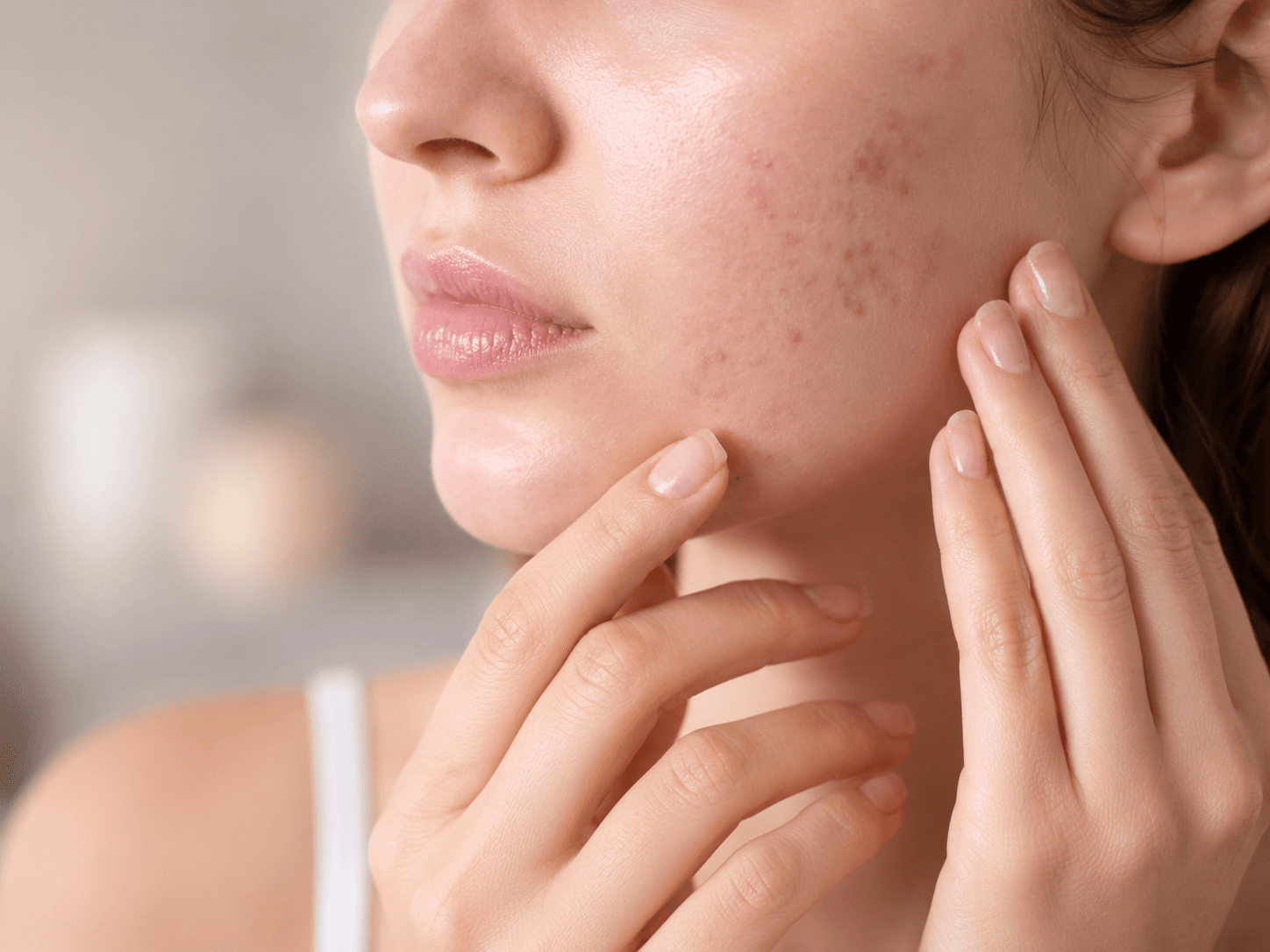 Cycle-related hormonal acne along the chin and jawline
